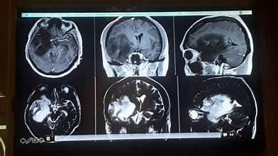Optimisasi CKD-TransBTS untuk Segmentasi Tumor Otak 3D